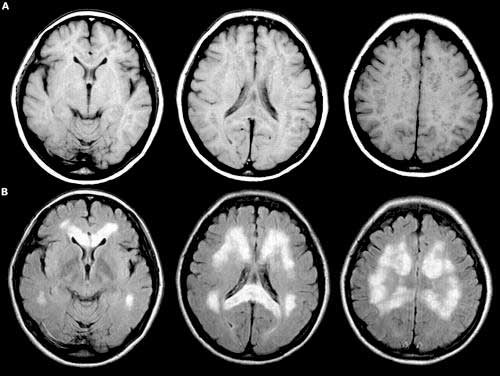 Что показывает КТ головного мозга