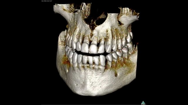 КТ челюсти и КТ зубов: это разные исследования?